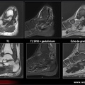 Synovite villonodulaire pigmentée: IRM